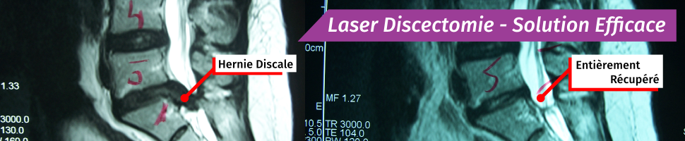 Laser Discectomie - Solution Efficace